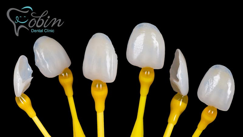 طول عمر مفید لمینت دندان